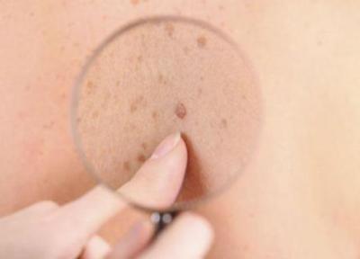 فیبر عامل تقویت سیستم ایمنی بدن در برابر سرطان پوست