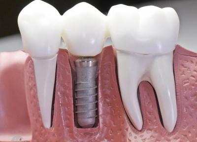 دندان های ایمپلنت هوشمند از نانوذرات مقاوم در برابر باکتری ها